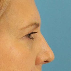 Browlift Before & After Patient #1402