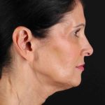 Co2 Laser Before & After Patient #3379