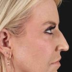 Upper Blepharoplasty Before & After Patient #3423
