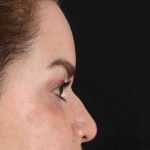 Upper Blepharoplasty Before & After Patient #3445