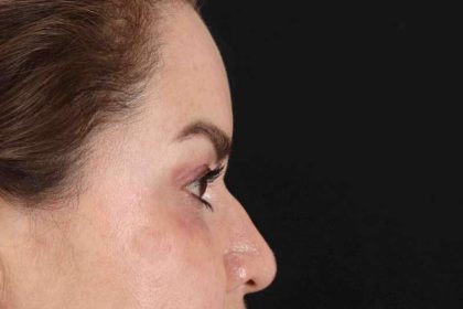 Upper Blepharoplasty Before & After Patient #3445