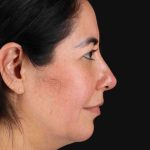 Upper Blepharoplasty Before & After Patient #3456