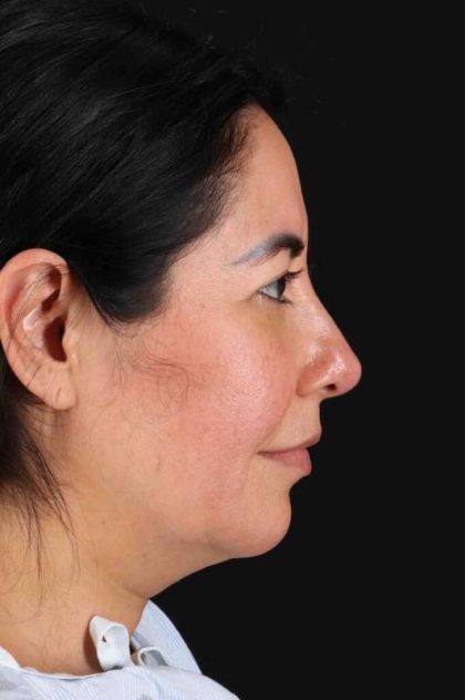 Upper Blepharoplasty Before & After Patient #3456