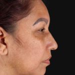 Upper Blepharoplasty Before & After Patient #3467