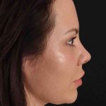 Buccal Fat Pad Before & After Patient #1425