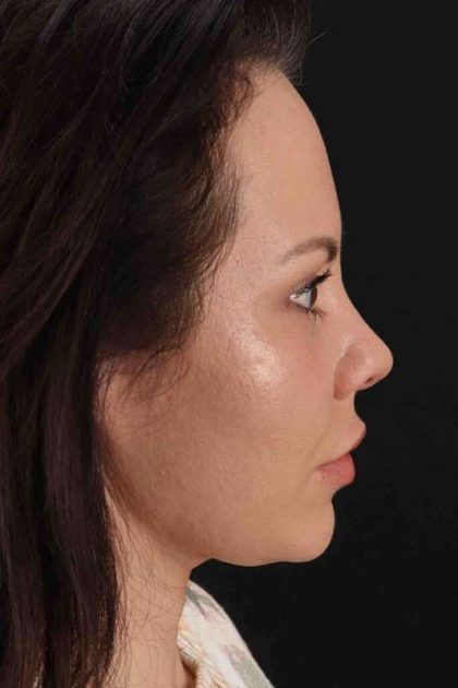 Buccal Fat Pad Before & After Patient #1425