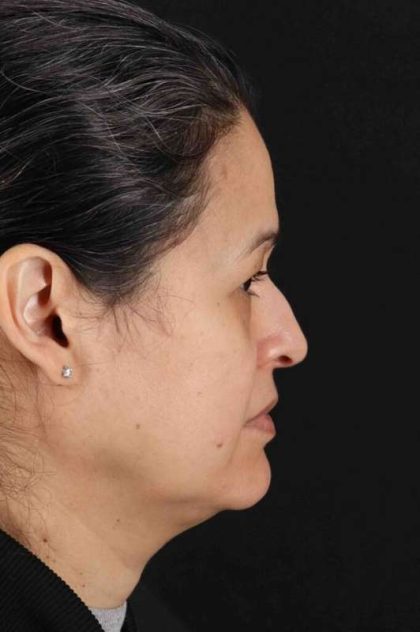 Upper Blepharoplasty Before & After Patient #3489