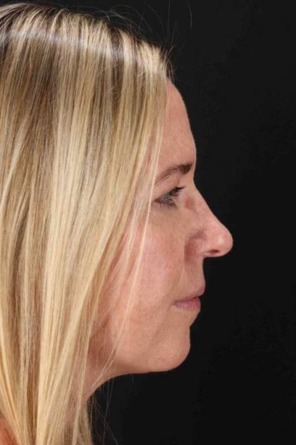 Upper Blepharoplasty Before & After Patient #3500