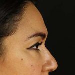 Upper Blepharoplasty Before & After Patient #3522