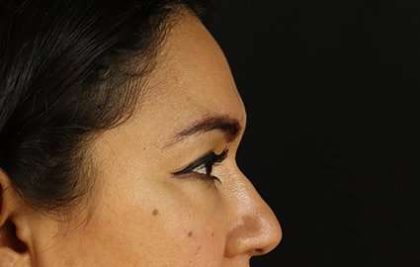 Upper Blepharoplasty Before & After Patient #3522