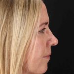 Rhinoplasty Before & After Patient #3566