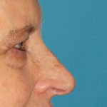 Lower Blepharoplasty Before & After Patient #2419