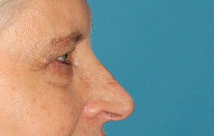 Upper Blepharoplasty Before & After Patient #3532