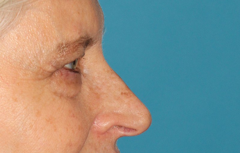 Upper Blepharoplasty Before & After Patient #3532