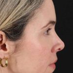 Browlift Before & After Patient #1231