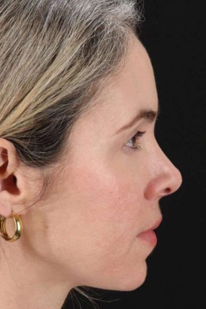 Browlift Before & After Patient #1231