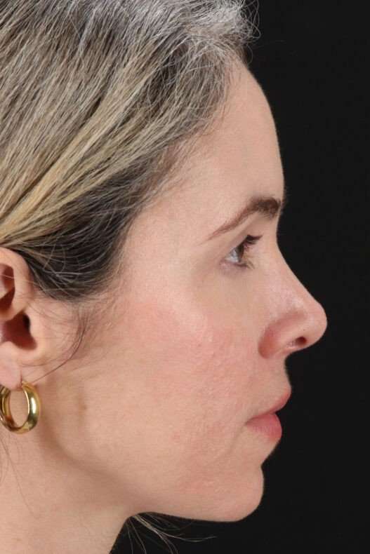 Browlift Before & After Patient #1231