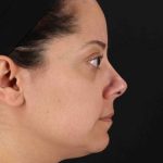 Buccal Fat Pad Before & After Patient #1436