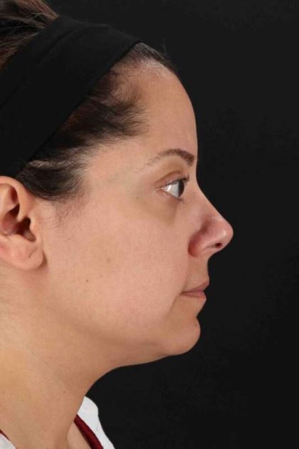 Buccal Fat Pad Before & After Patient #1436