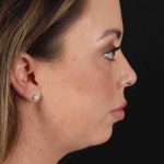 Buccal Fat Pad Before & After Patient #1447