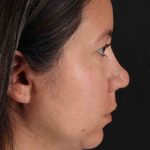 Buccal Fat Pad Before & After Patient #1458