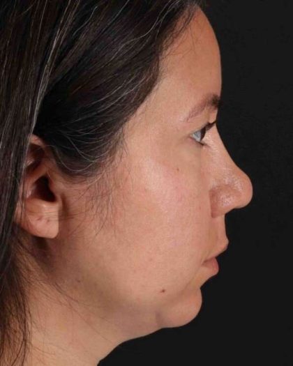 Buccal Fat Pad Before & After Patient #1458