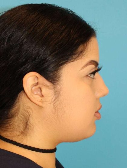 Buccal Fat Pad Before & After Patient #1485