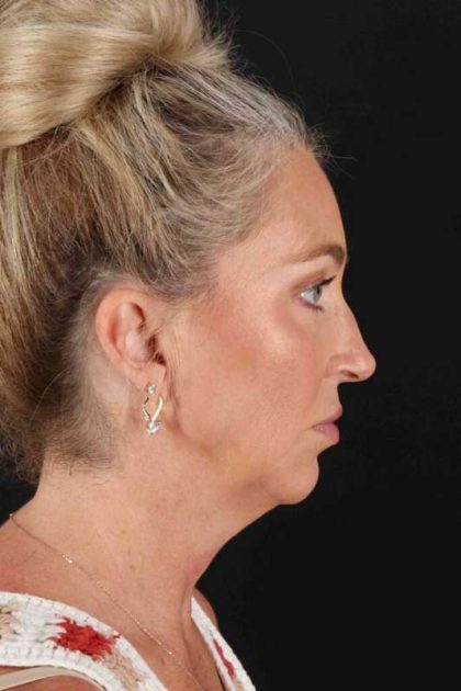 Chin Implant Before & After Patient #1496