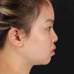 Chin Implant Before & After Patient #1507