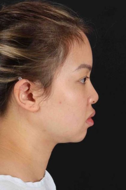 Chin Implant Before & After Patient #1507