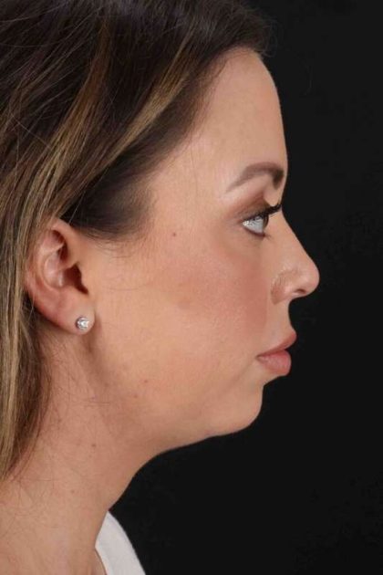Chin Implant Before & After Patient #1518
