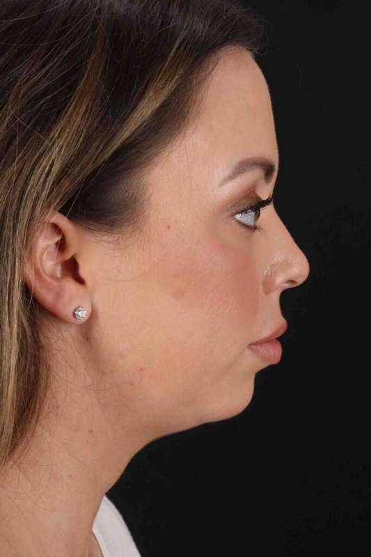 Chin Implant Before & After Patient #1518