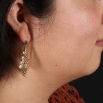 Chin Implant Before & After Patient #1529