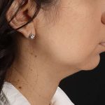 Chin Implant Before & After Patient #1540