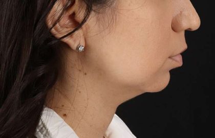 Chin Implant Before & After Patient #1540