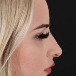 Browlift Before & After Patient #1242