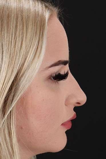 Browlift Before & After Patient #1242
