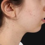 Chin Implant Before & After Patient #1551