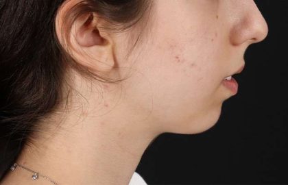 Chin Implant Before & After Patient #1551