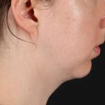 Chin Implant Before & After Patient #1562