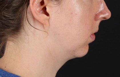 Chin Implant Before & After Patient #1562