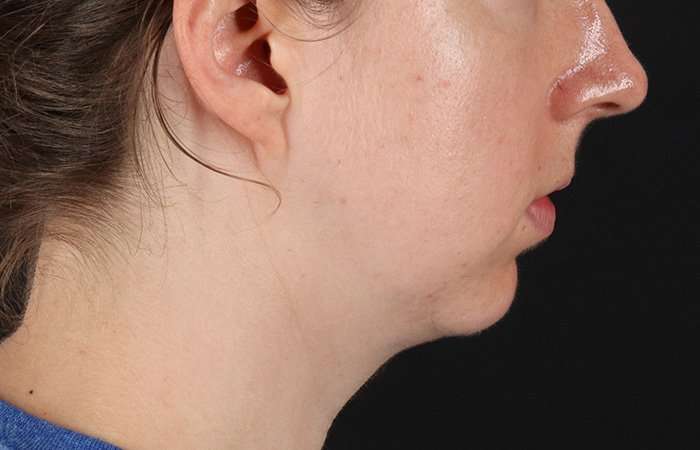 Chin Implant Before & After Patient #1562