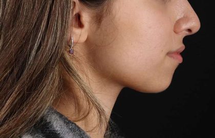 Chin Implant Before & After Patient #1573