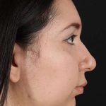 Chin Implant Before & After Patient #1604