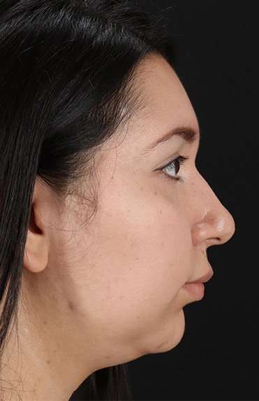 Chin Implant Before & After Patient #1604