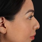 Chin Implant Before & After Patient #1626