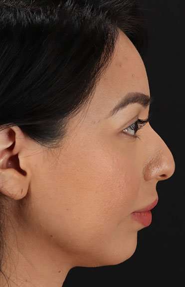 Chin Implant Before & After Patient #1626