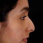 Chin Implant Before & After Patient #1637