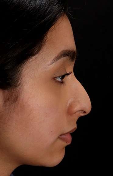 Chin Implant Before & After Patient #1637