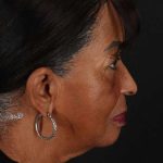Chin Implant Before & After Patient #1648
